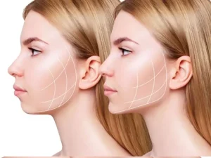 عکس جراحی بوکال فت