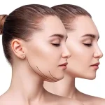 عکس ساکشن غبغب