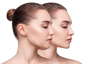 عکس ساکشن غبغب