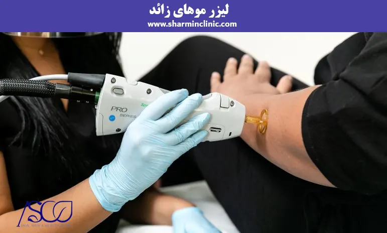 لیزر موهای زائد