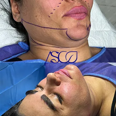 مزایای ساکشن غبغب