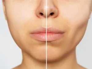 هزینه جراحی بوکال فت