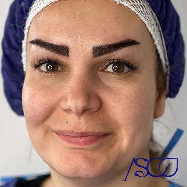 کاشت ابرو کلینیک آسو