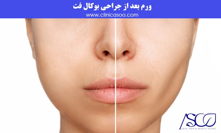 ورم بعد از جراحی بوکال فت