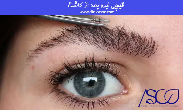 قیچی ابرو بعد از کاشت