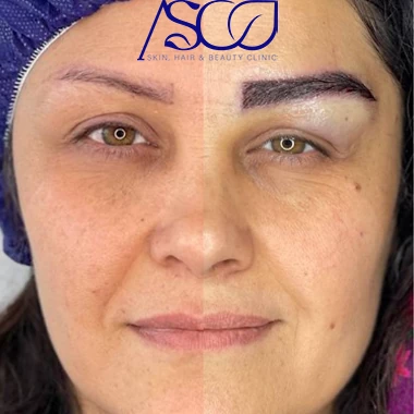 کاشت ابرو آسو