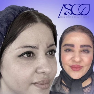 کاشت ابرو کلینیک آسو