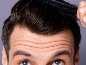 مراحل انجام کاشت مو بدون نیاز به تراشیدن موها