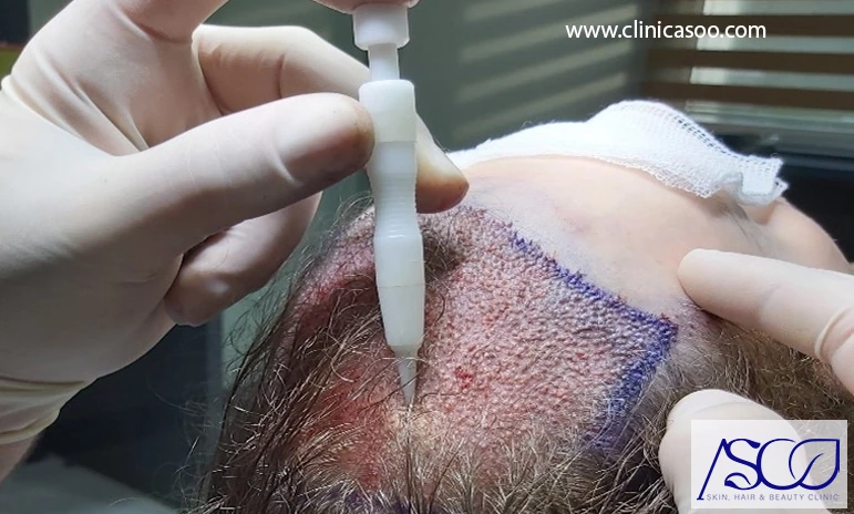 مزایای کاشت مو بدون تراشیدن سر