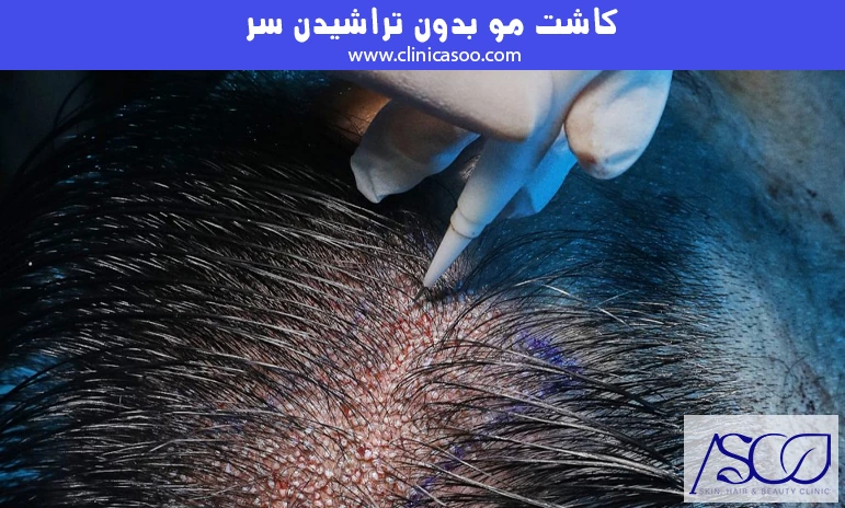 کاشت مو بدون تراشیدن سر