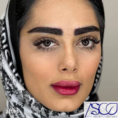 بعد از کاشت در بهترین کلینیک کاشت ابرو