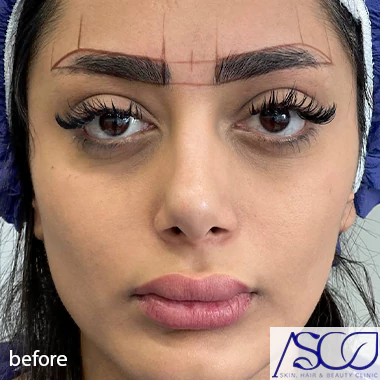 قبل کاشت در بهترین کلینیک کاشت ابرو