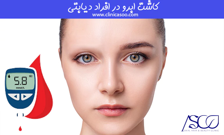 کاشت ابرو در افراد دیابتی