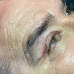 جراحی زیبایی پلک