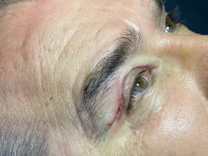 جراحی زیبایی پلک