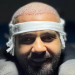 عکس کاشت مو