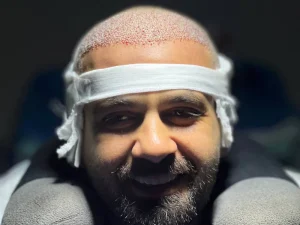 عکس کاشت مو