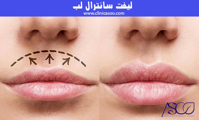 لیفت سانترال لب