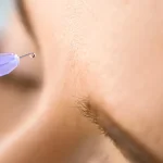 مزایای بوتاکس