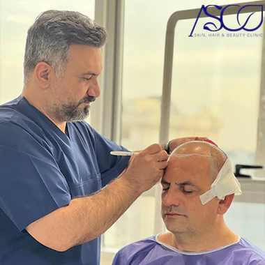 کاشت مو در کلینیک آسو