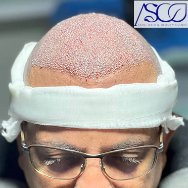 کاشت مو در کلینیک زیبایی آسو