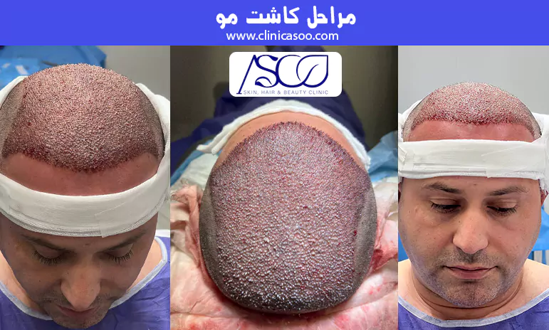 مراحل کاشت مو