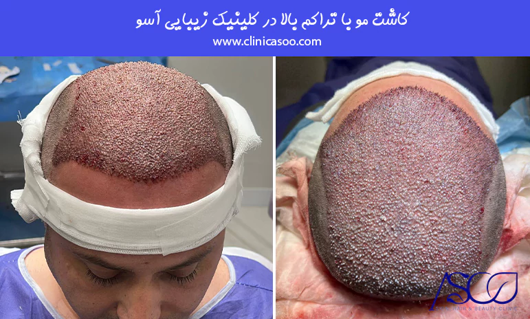 بهترین کلینیک کاشت مو سعادت آباد