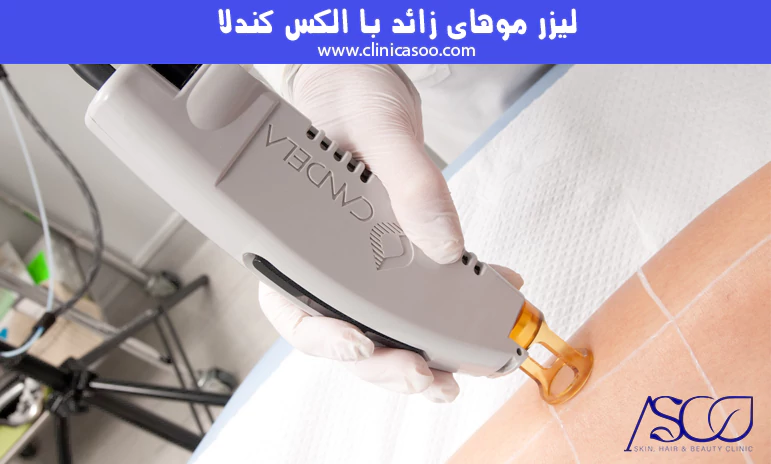 لیزر موهای زائد با الکس کندلا