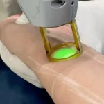 لیزر موی زائد با الکس کندلا