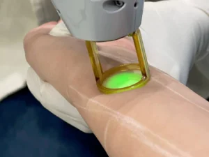 لیزر موی زائد با الکس کندلا