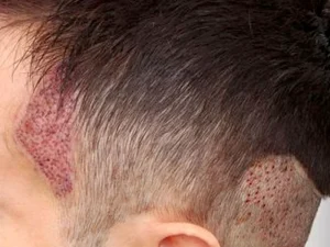 مراحل کاشت موی شقیقه