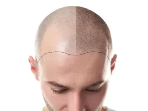 مراحل کامل کاشت مو