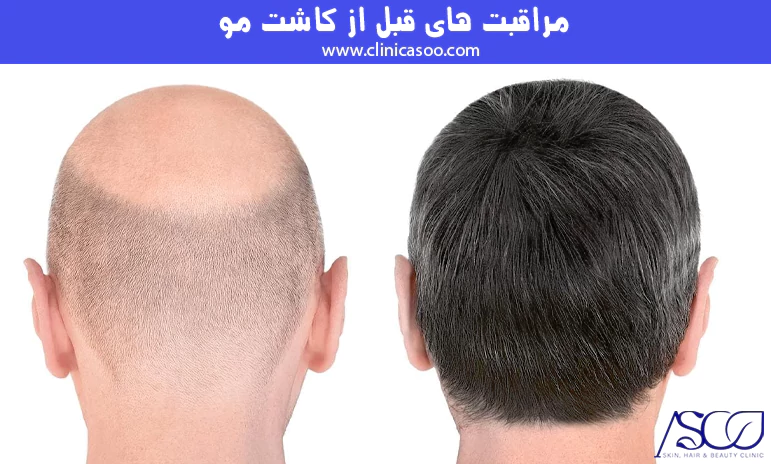 مراقبت های قبل از کاشت مو