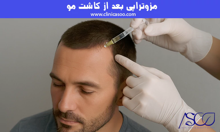 مزوتراپی بعد از کاشت مو