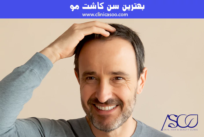 بهترین سن کاشت مو