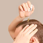 دلایل مصرف ماینوکسیدیل بعد از کاشت مو