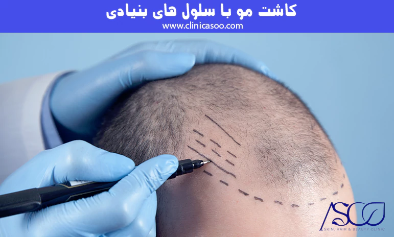 کاشت مو با سلول ها بنیادی