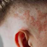 کاشت مو برای افراد پسوریازیس