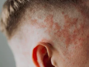 کاشت مو برای افراد پسوریازیس