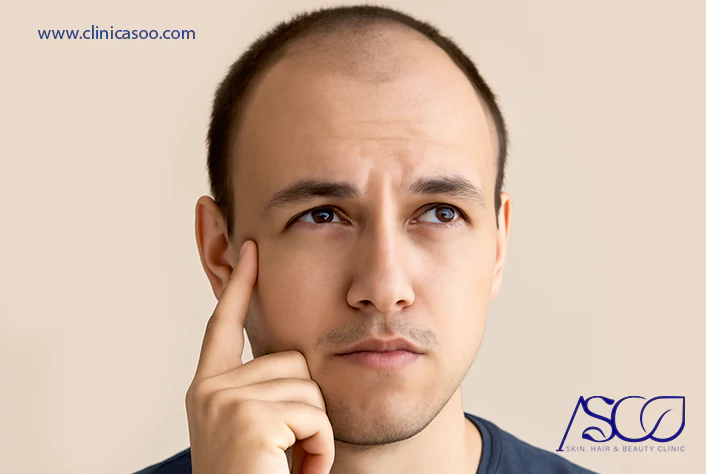 کاشت مو زیر ۲۵ سال