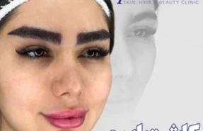کلینیک آسو بهترین کلینیک کاشت ابرو