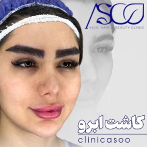 کلینیک آسو بهترین کلینیک کاشت ابرو