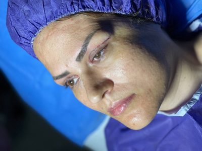 بلفاروپلاستی در کلینیک آسو