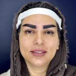 کاشت ابرو در کلینیک آسو: راهنمای جامع مراقبت و بهبودی