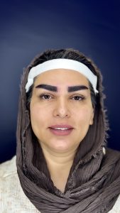 کاشت ابرو در کلینیک آسو: راهنمای جامع مراقبت و بهبودی