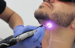 لیزر موهای زائد، حکم شرعی لیزر موهای زائد، آیا لیزر موهای زائد حرام است، حکم لیزر در اسلام، لیزر بیکینی از نظر شرعی، نظر مراجع درباره لیزر