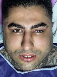 بلفاروپلاستی در کلینیک آسو