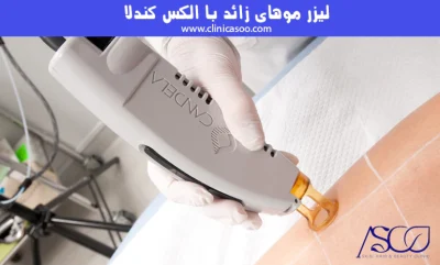 لیزر موهای زائد با الکس کندلا در کلینیک آسو سعادت‌آباد
